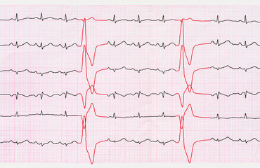 Tape ECG with ventricular premature beats (quadrigeminia)