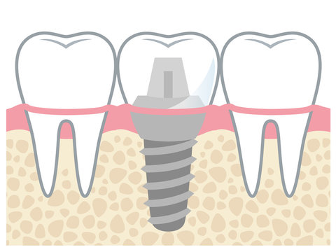 歯　インプラント　構造
