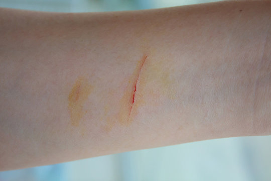 cuts on girls arms