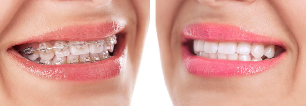 Before and after braces treatment