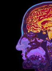 MRI Scan Of Head Showing Brain