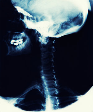 X Ray Image Showing Skull, Jaw And Spine