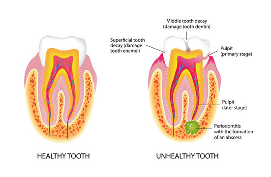 Healthy and unhealthy tooth