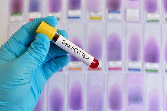 Blood for beta-hCG test