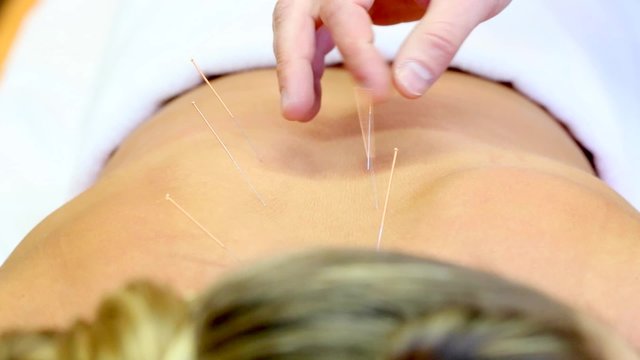 Frau bei Akupunktur mit Nadeln im Rücken