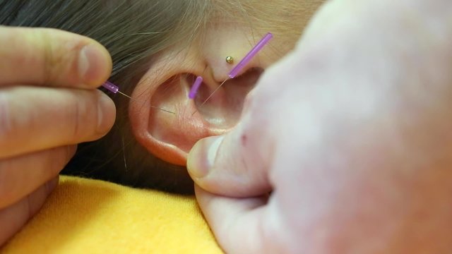 Ohr von Frau mit Akupunktur Nadeln