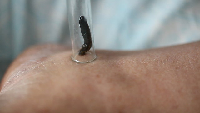 the procedure hirudotherapy, leech therapy