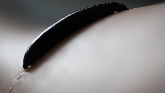 the procedure hirudotherapy, leech therapy