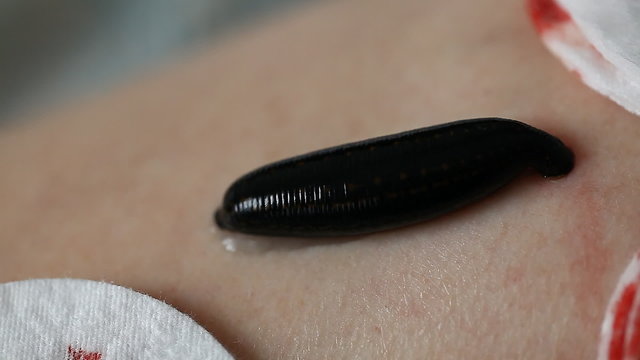 the procedure hirudotherapy, leech therapy