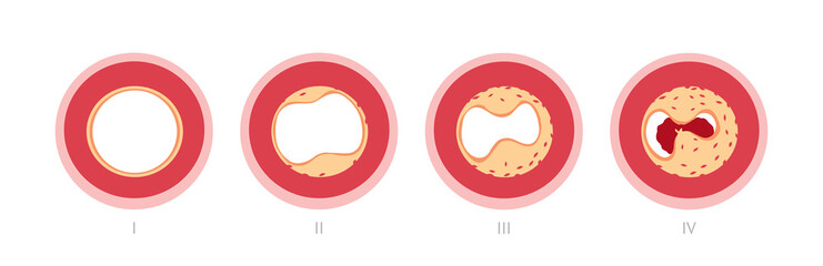 Atherotrombosis in vessels
