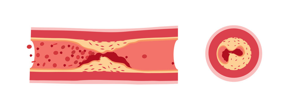 Atherotrombosis in vessels