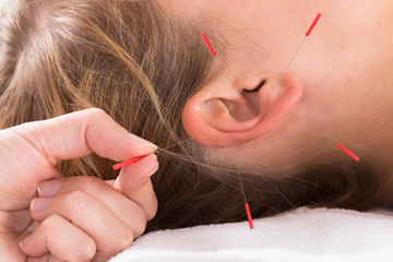 Hand Performing Acupuncture Therapy On Auricle