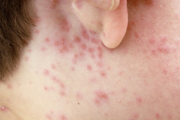 detail of chicken pox effects