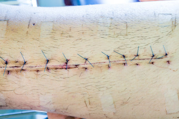 scar from operation suture with a blue fiber at leg patient