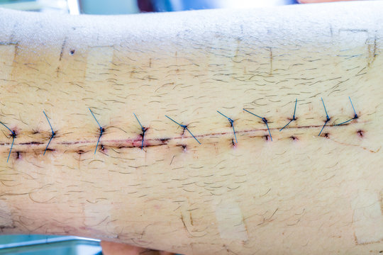 scar from operation suture with a blue fiber at leg patient