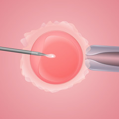 in vitro fertilization