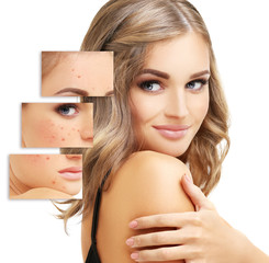 Acne.Portrait of beautiful girl  with problem and clear skin 