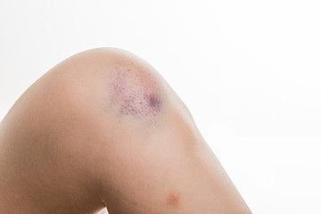 Fototapeta premium knee injury and pain