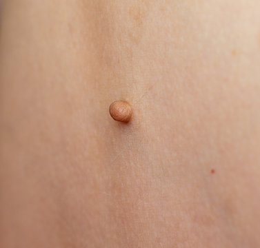 close up mole on human skin