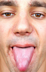 Infection tongue and acne