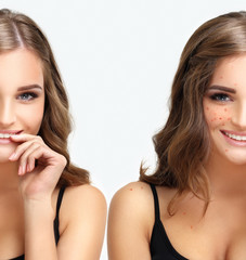 Acne, beautiful teenage girl with problem and clear skin