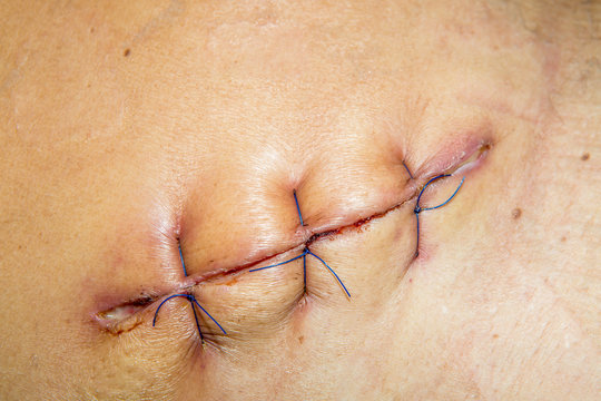 scar from operation suture with a blue fiber
