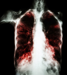 Pulmonary Tuberculosis  ( film chest x-ray :  interstitial infiltrate both lung due to...