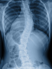 Scoliosis film x-ray show spinal bend in teenager patient - obrazy, fototapety, plakaty