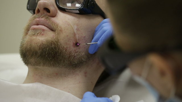 The doctor removes a birthmark laser