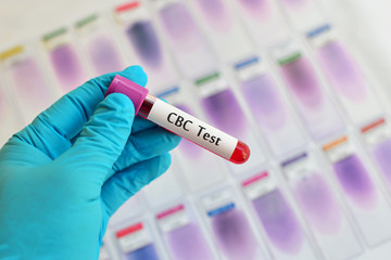 Blood sample for complete blood count (CBC) test