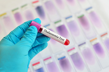 Fototapeta premium Blood for thalassemia test