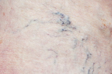 Varicose veins