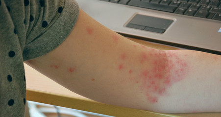 skin rash, allergy