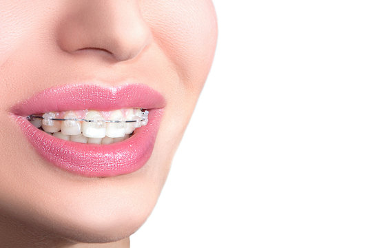 Closeup Ceramic Braces on Teeth. Beautiful Female Smile with Braces. Orthodontic Treatment. Dental care Concept. 