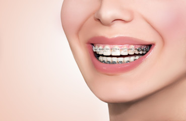 Ceramic Dental Braces Teeth. Closeup Female Smile.