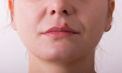 Fototapeta premium Girl lip diseased herpes. scabs on the stage of drying