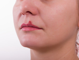 Obraz premium Girl lip diseased herpes. scabs on the stage of drying