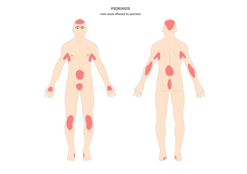 principali aree del corpo umano colpite dalla psoriasi
