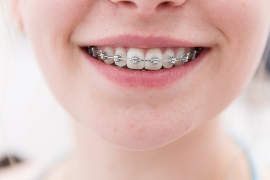 lachender Mund eines Mädchens mit Zahnspange