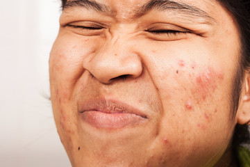 women show hair at nose and acne on face