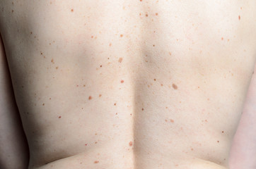 Skin on a womans back with moles