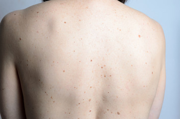 Skin on a womans back with moles
