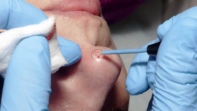 Dermatologist surgeon performs microsurgery on the nose using electrocoagulation to remove benign tumor