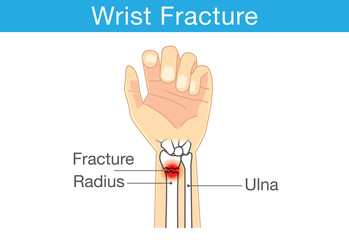 Diagram of wrist have bone fracture - obrazy, fototapety, plakaty