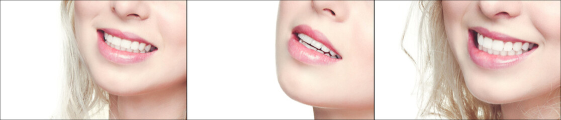 Woman smile. Teeth whitening. Dental care.