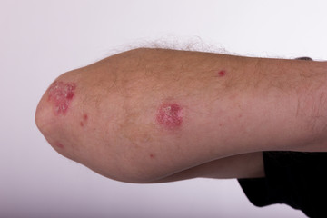 Men's hand diseased psoriasis, elbow. arm bent at the elbow