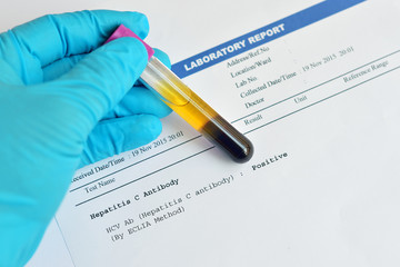 Blood sample with hepatitis C virus positive result