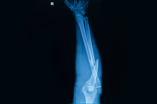 Collection of human x-rays  showing fracture  of  radius  bone