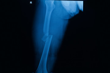 Film x-ray fructure right femur( right  thigh )