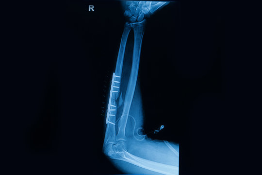 Collection of human x-rays  showing fracture  of radius  bone